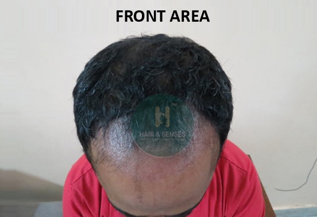 Hair Transplant